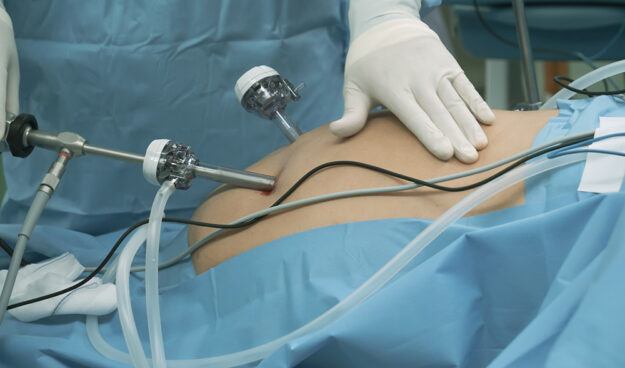 bariatric-surgery-riverside