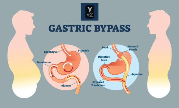 gastric-bypass-riverside gastric-bypass-riverside