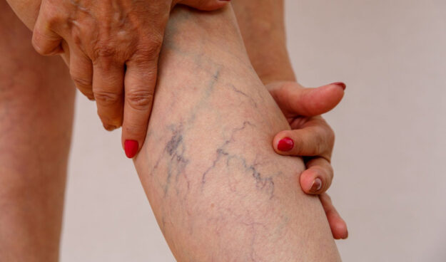 varicose-veins-riverside-ca