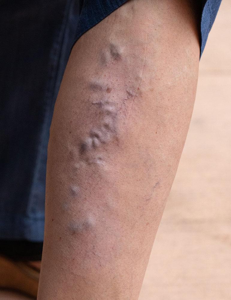 Varicose vein clinic in Riverside and Corona