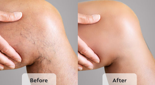varicose veins treatment