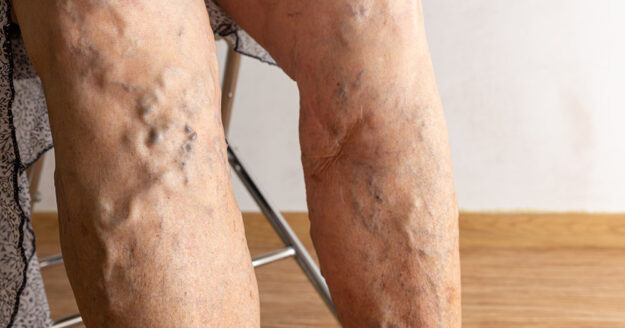 varicose vein treatment varicose vein treatment