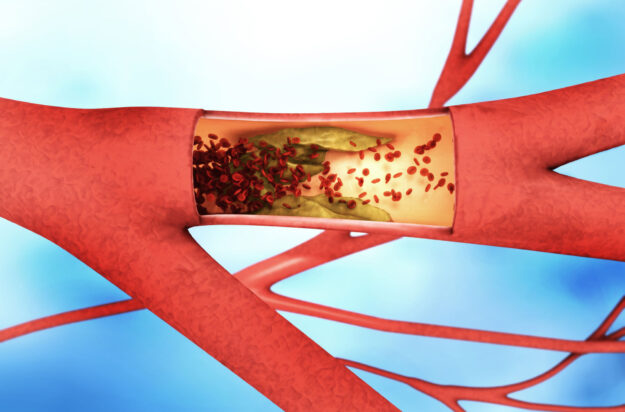 peripheral_artery_disease peripheral_artery_disease