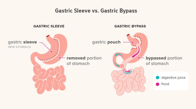 Gastrectomy vs. Gastric Bypass