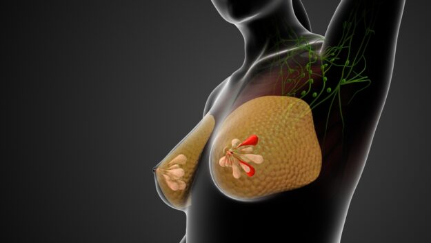 Breast cancer surgery Breast cancer surgery