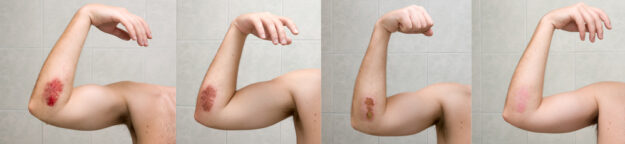 Wound,Healing,Process,Xxl.,Painful,Bruise,Of,Elbow,Shot,During wound healing Riverside Corona