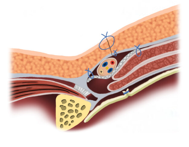hernia mesh removal signs hernia mesh removal signs