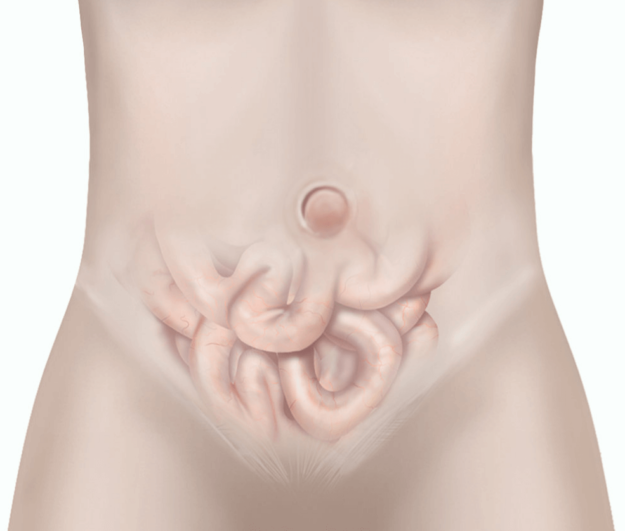 chronic groin pain after hernia surgery chronic groin pain after hernia surgery