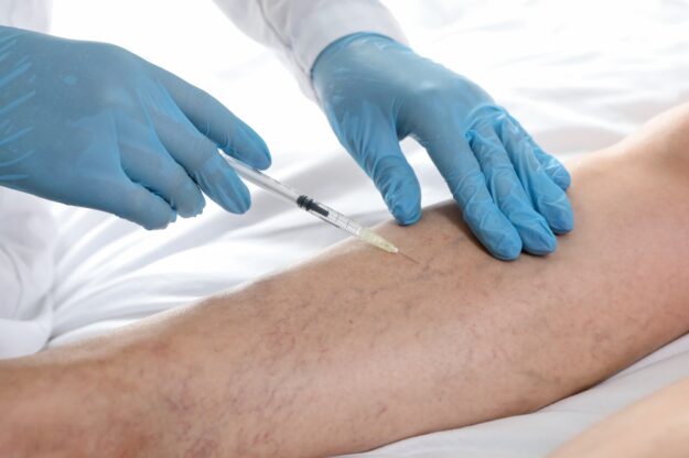 varicose vein flare-up in summer varicose vein flare-up in summer