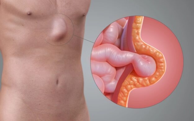 Early warning signs of a hernia Early warning signs of a hernia