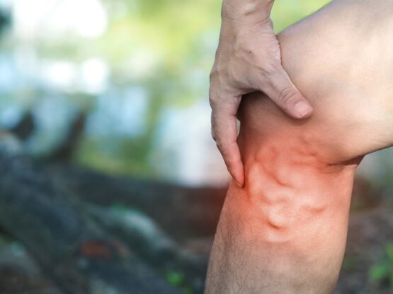 prevent varicose veins Riverside prevent varicose veins Riverside