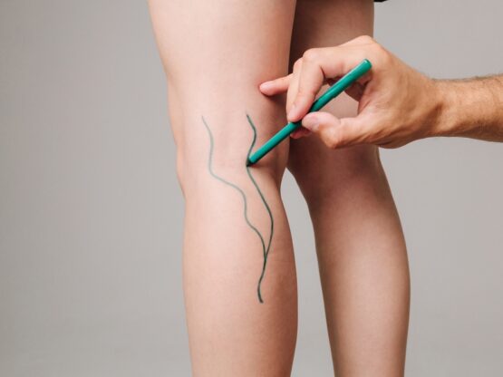 minimally invasive vascular surgery Riverside minimally invasive vascular surgery Riverside