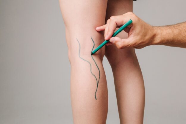 minimally invasive vascular surgery Riverside