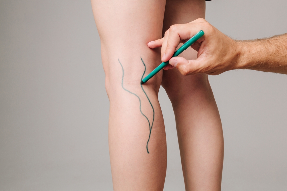 minimally invasive vascular surgery Riverside minimally invasive vascular surgery Riverside
