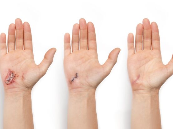 wound healing Riverside hot climate wound healing Riverside hot climate