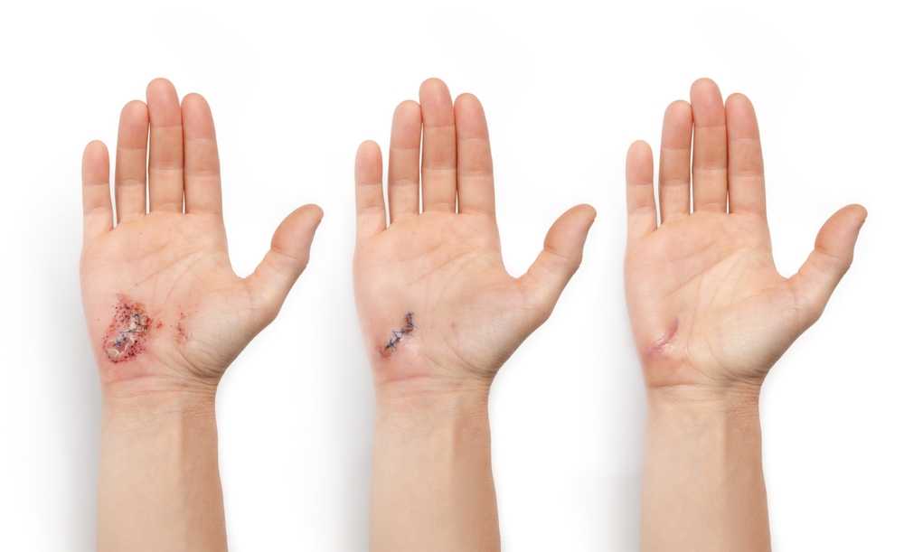 wound healing Riverside hot climate wound healing Riverside hot climate