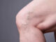 Varicose Vein Treatment