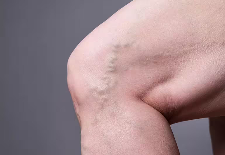 Varicose Vein Treatment Varicose Vein Treatment